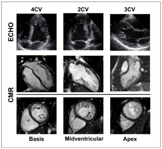 【佳学基因检测】儿童左心室致密化不全基因检测及形态功能学分析对治疗的影响